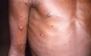 US Validates 1st Situation Of Monkeypox – Guy That Recently Travelled To Canada