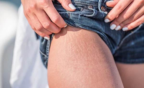 5 Easy And Affordable Ways To Reduce Cellulite